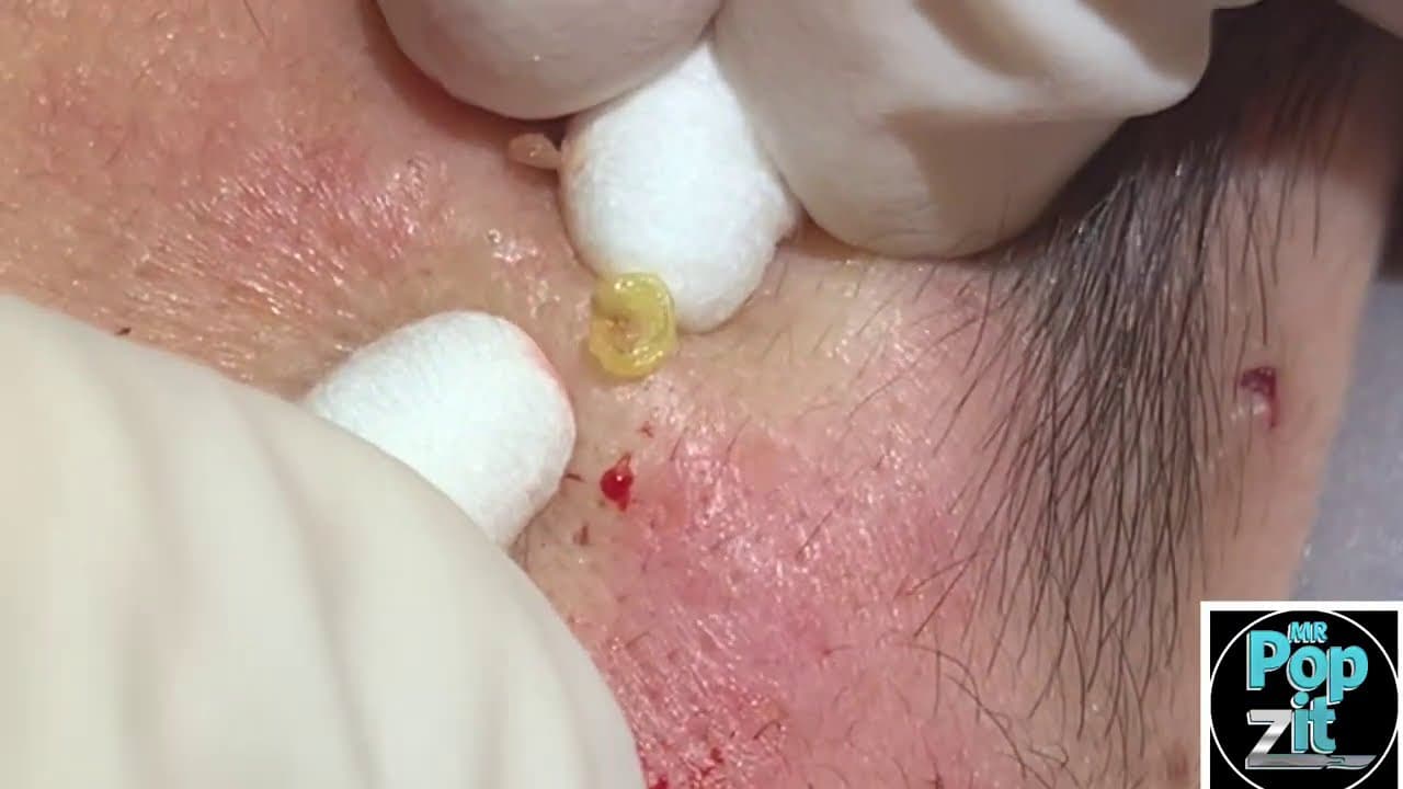 Your new Fave Extractions Part 3! Over 17 minutes of just pops. I edit out all the prep. Acne pops.